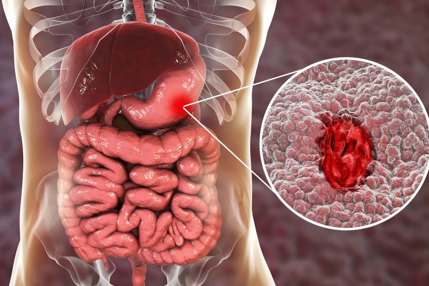Cirugía de tumores gastrointestinales