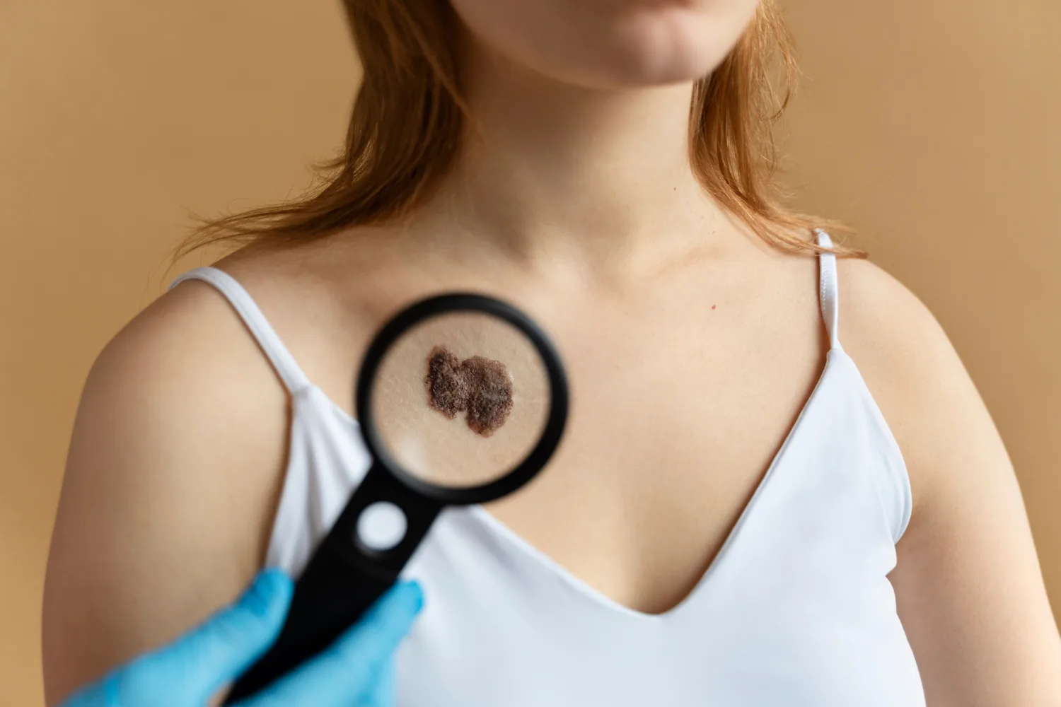 Manejo quirúrgico de cáncer de piel y melanoma